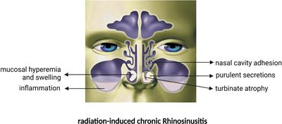 Impairment mechanism of nasal mucosa after radiotherapy for nasopharyngeal carcinoma